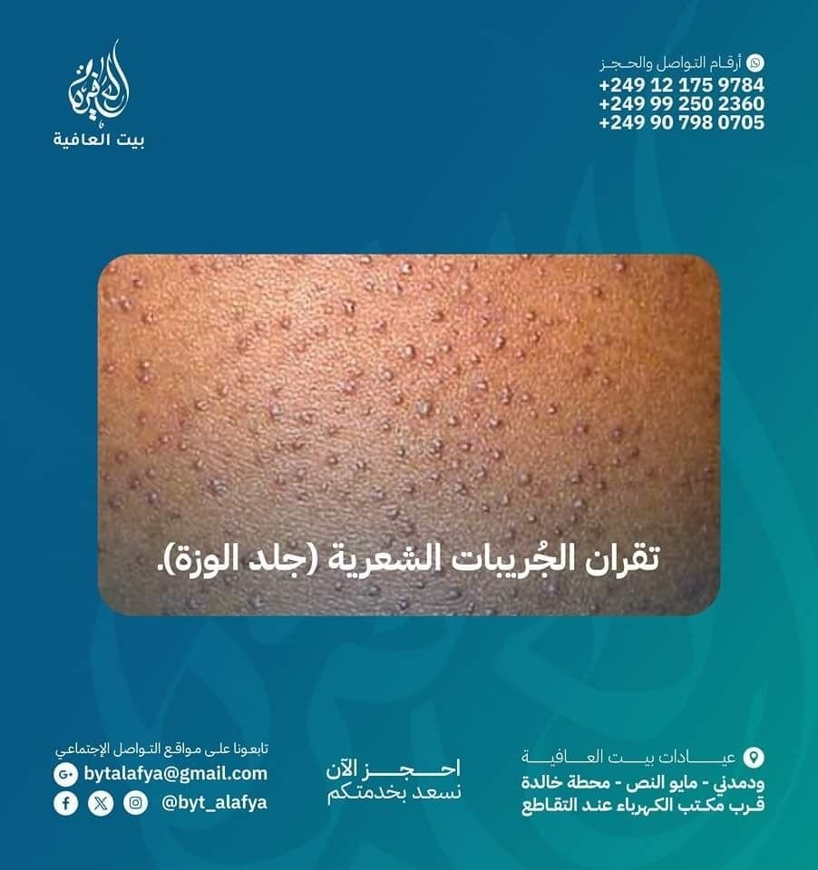 فهم حالة الجلد المسماة بـ تَقْرانُ الجُرَيباتِ الشَّعْرِيَّة (جلد الإوزه) K