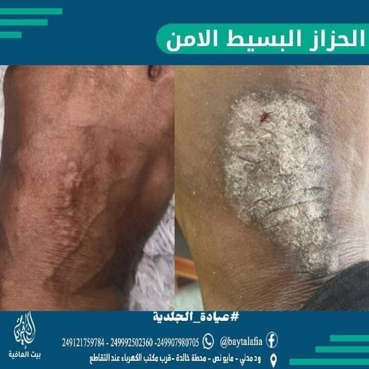الحزاز البسيط المزمن Lichen Simplex Chronicus
