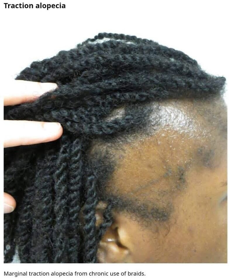 صلع الشد (traction alopecia)