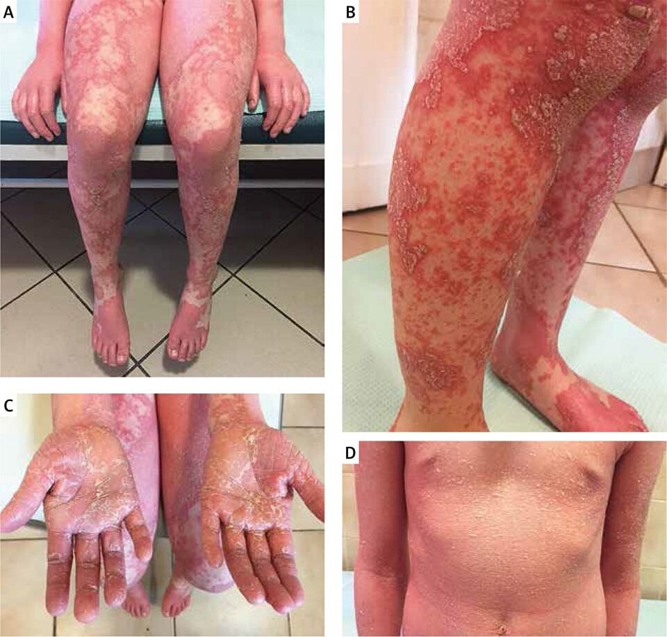ُ الحَمراء الشَّعرِيَّة عند الأطفال (Pityriasis Rubra Pila)
