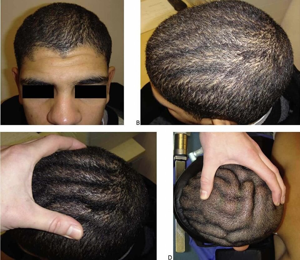 تعرّف على مرض جِلْدُ الفَرْوَةِ و التَّلاَفيف (Cutis Verticis Gyrat)