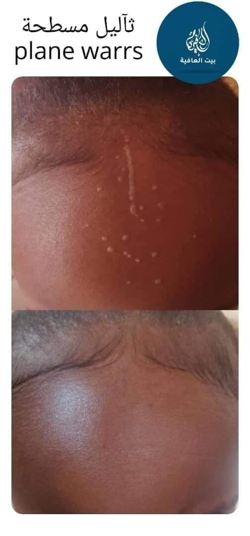 الثآليل السطحية (plane warts) تسببها عدوى فيروسية وتظهر كحبوب مسطحة بالجسم