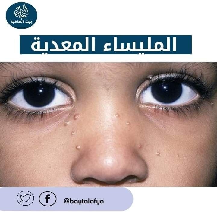 الـمُلَيساء الـمُعدِية (Molluscum Contagiosum)