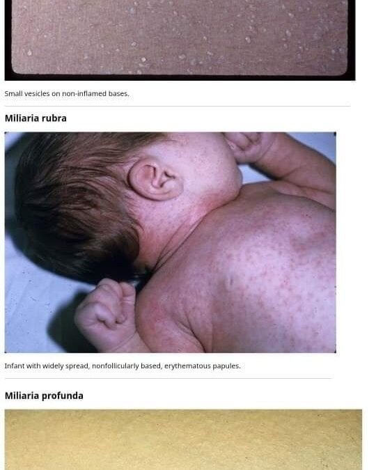 حمو النيل Miliaria