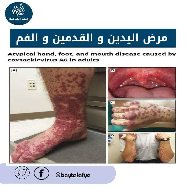 مرض اليدين والقدمين والفم Hand Foot & Mouth Disease