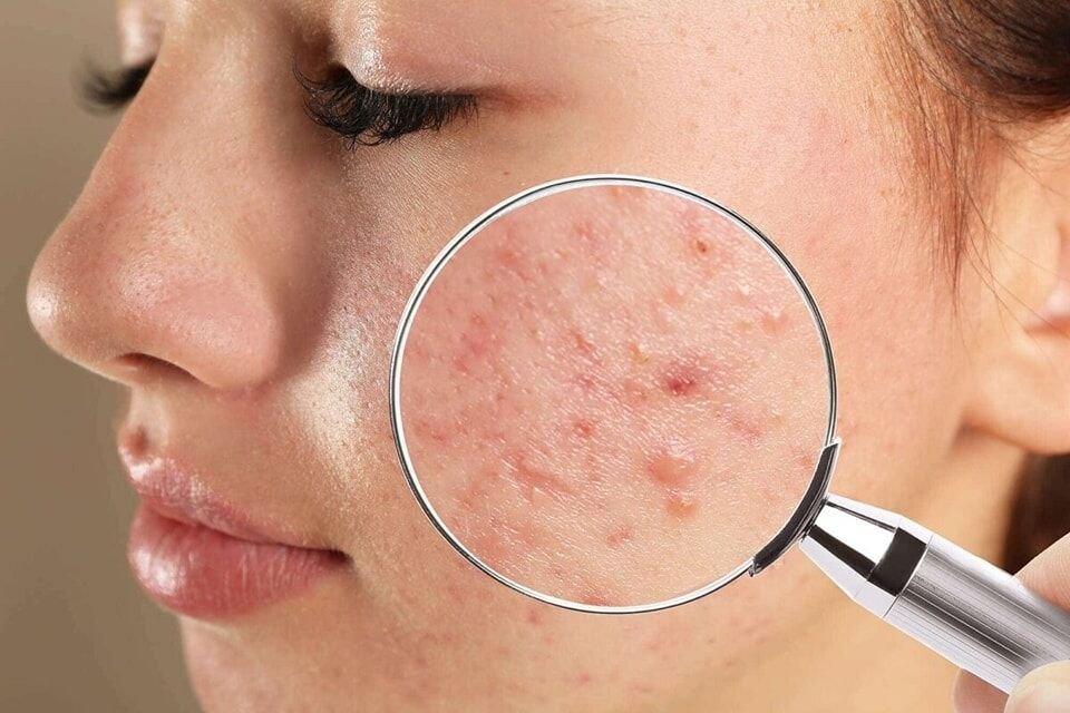 🌟 طرق الوقاية والعلاج المنزلي لحب الشباب 🌟