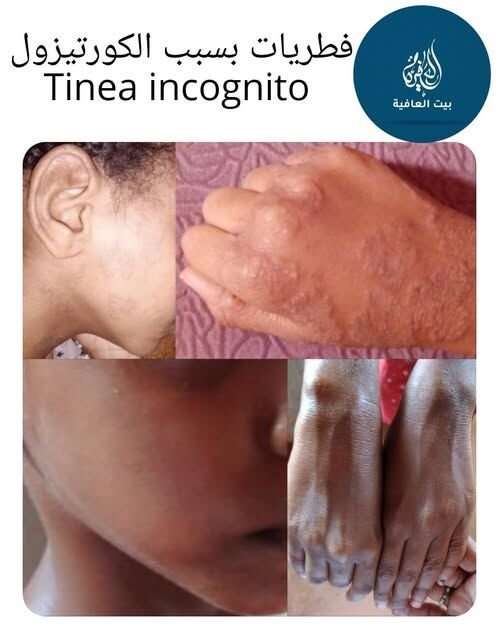 فطريات جلدية بسبب سوء استعمال الكورتيزون (Tinea incognito) — قبل وبعد العلاج