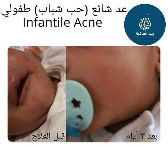 العد الشائع الطفولي (حب شباب الرضع) — قبل وبعد العلاج