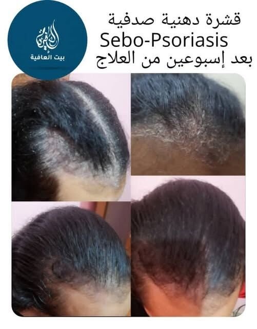 القشرة الدهنية الصدفية (Sebo-Psoriasis) — بعد أسبوعين من العلاج