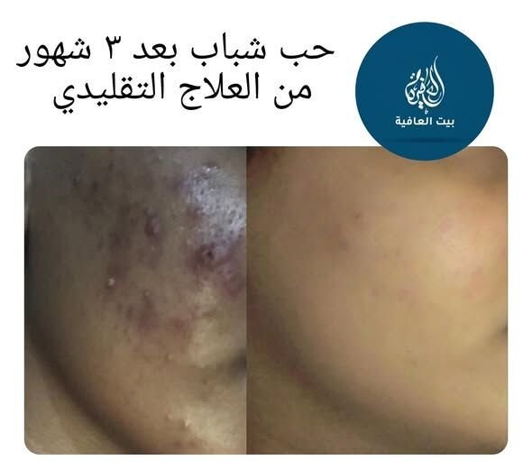 حب الشباب — بعد ٣ شهور من العلاج التقليدي