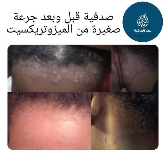 الصدفية — قبل وبعد جرعة صغيرة من الميثوتريكسيت