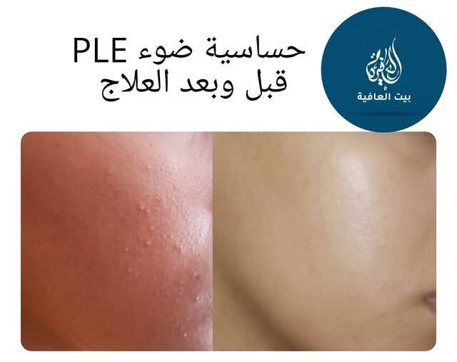 حساسية الضوء (PLE) — قبل وبعد العلاج