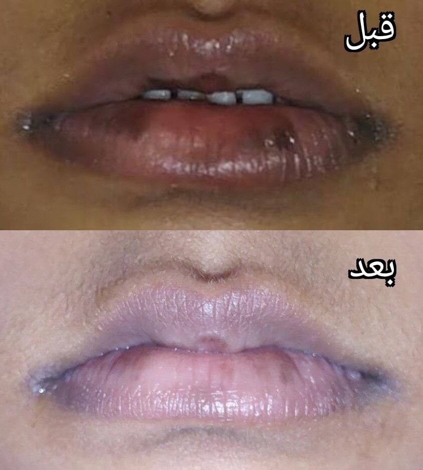 فرط تصبّغ الشفتين — قبل وبعد العلاج