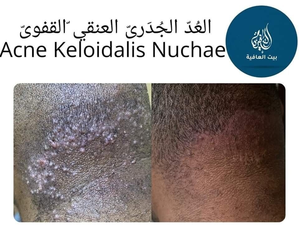 العُدّ الجُدَريّ العنقيّ القفويّ (Acne Keloidalis Nuchae) — قبل وبعد العلاج