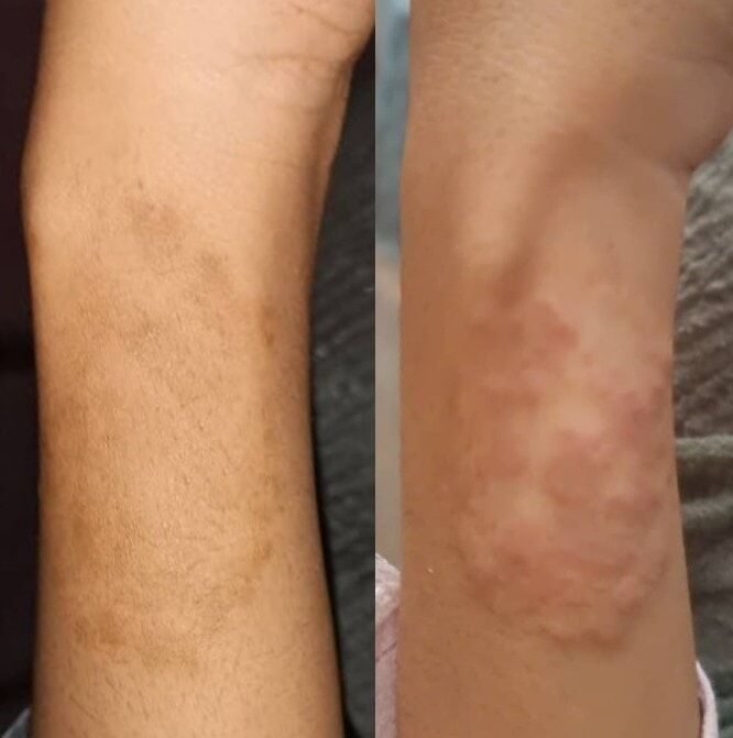 الفطريات المتنكّرة (Tinea Incognito) — قبل وبعد العلاج
