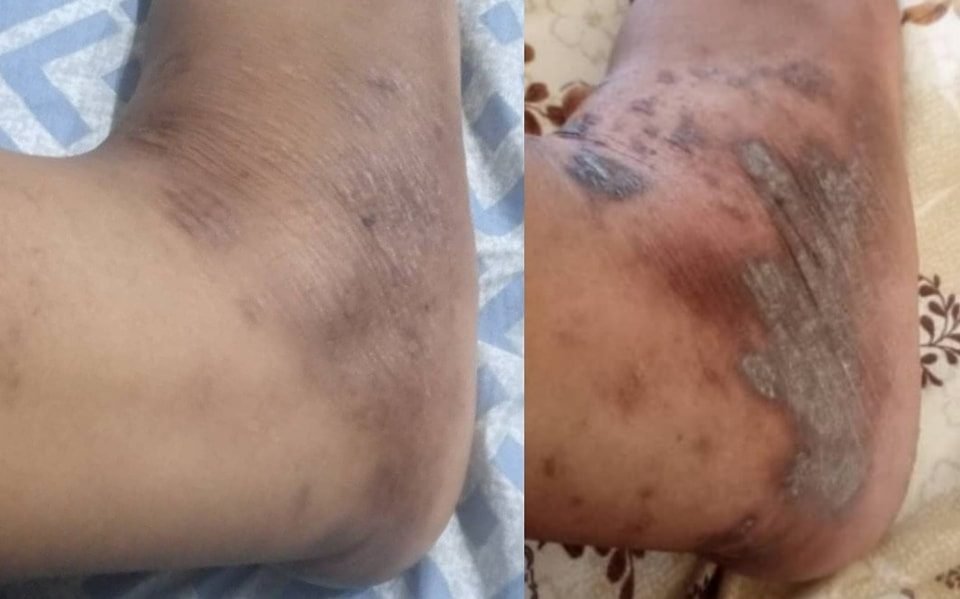 أكزيما القدمين — قبل وبعد العلاج