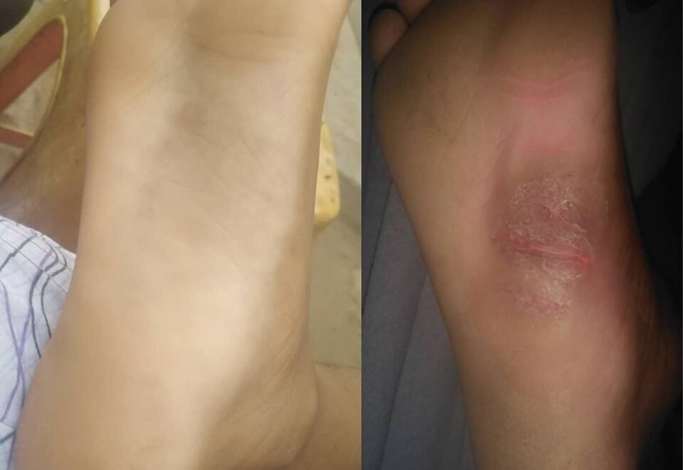الأكزيما المصابة بعدوى — قبل وبعد العلاج