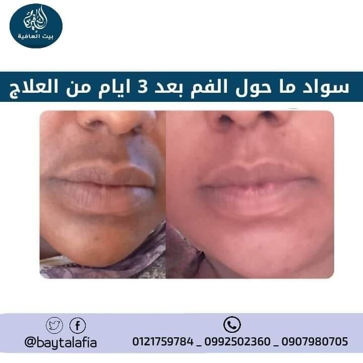 فرط التصبّغ حول الفم — قبل وبعد العلاج