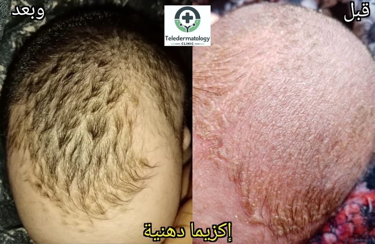 التهاب الجلد الدهني عند الرضّع — قبل وبعد العلاج