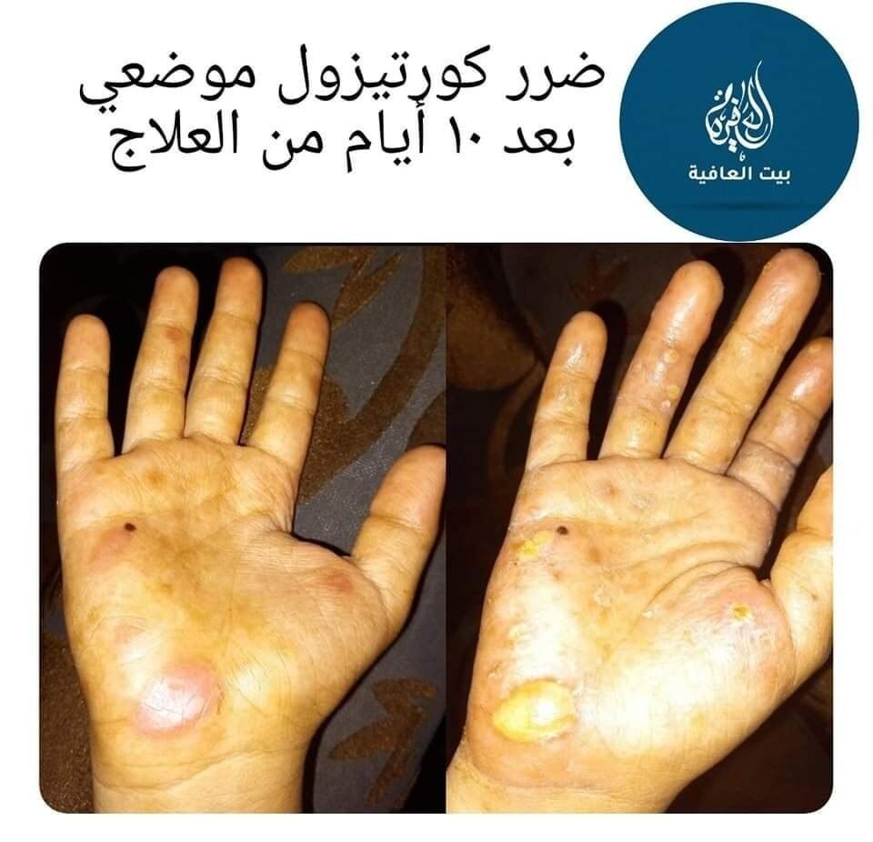 التهاب الجلد المُحدَث بالكورتيزون — قبل وبعد العلاج