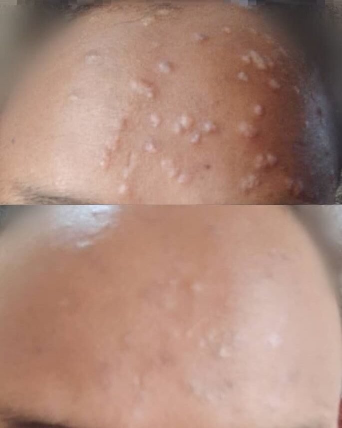 الثآليل — قبل وبعد العلاج