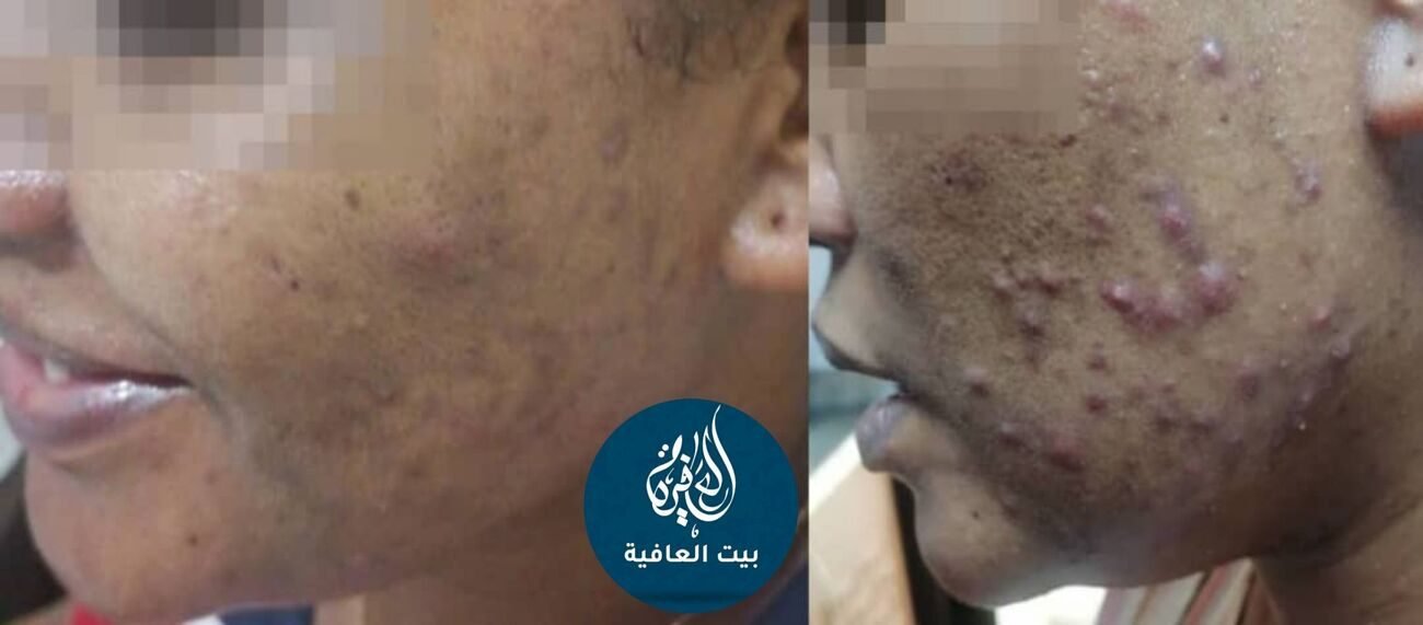 حب الشباب — قبل وبعد العلاج