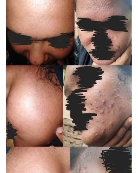 حب شباب شديد — قبل وبعد العلاج