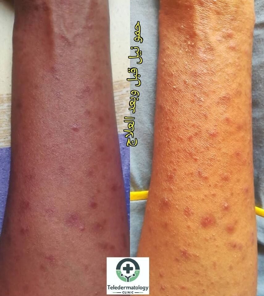 حمو النيل (الدُّخَنية) — قبل وبعد العلاج