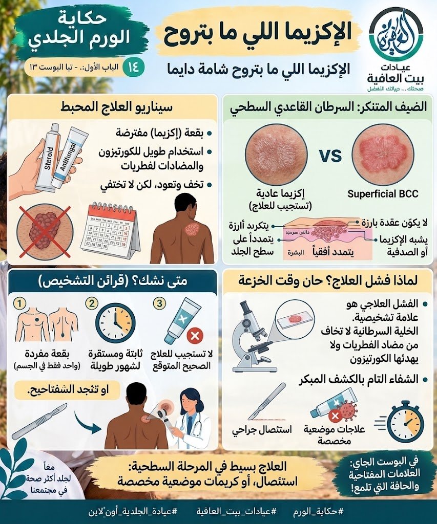 الإكزيما اللي ما بتروح